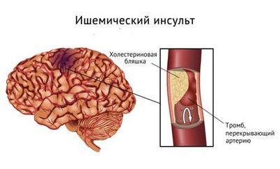 инсульт инсульт